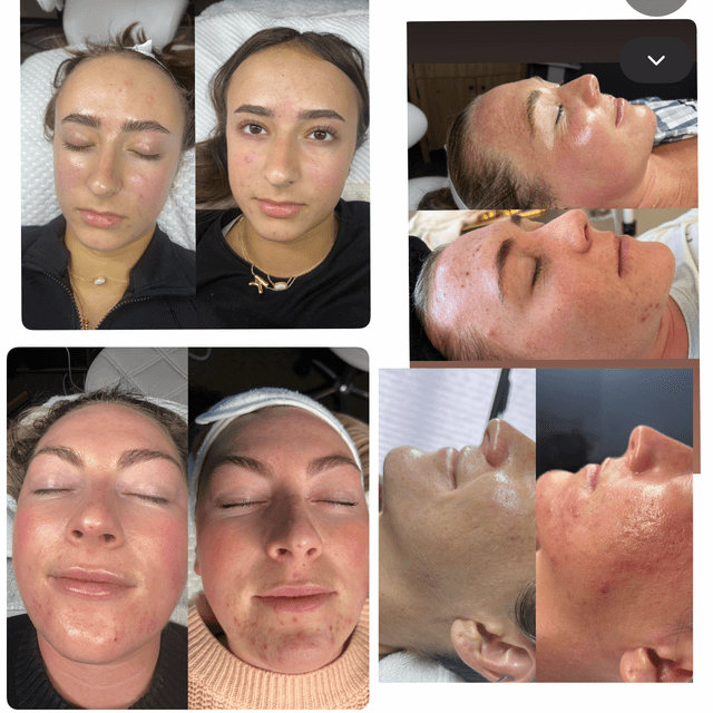 Clear Skin Club at The Acne Fairy in Loveland, CO